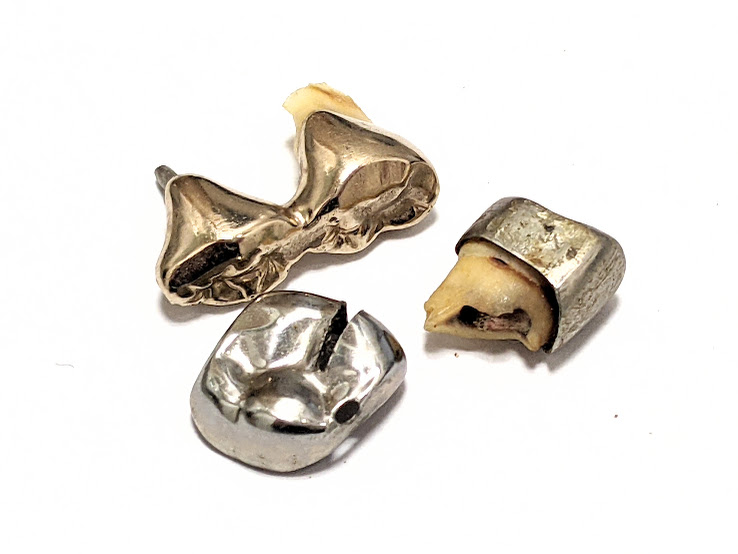 金歯,貴金属,買取